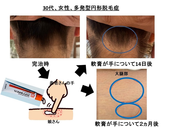 円形脱毛症　病院